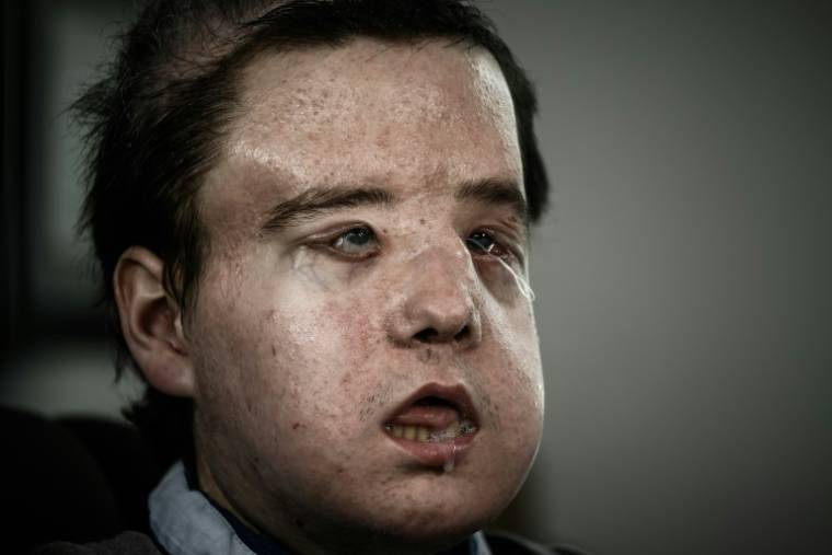Jérôme Hamon, qui a subi deux fois une greffe du visage après que des comprimés antigrippaux incompatibles avec son traitement anti-rejet aient conduit à l'échec de la première opération, le 13 avril 2018 à l'Hôpital Européen Georges-Pompidou à Paris ( AFP / Philippe LOPEZ )