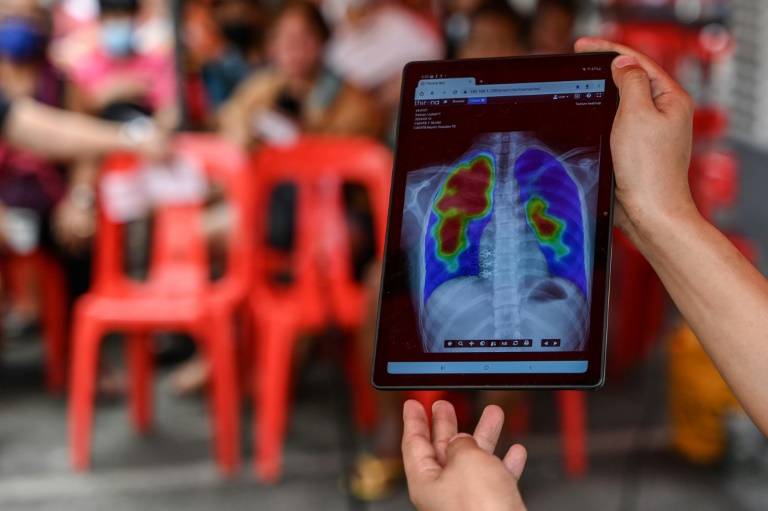 Un travailleur médical montre le résultat d'une radiographie lors d'un dépistage de la tuberculose dans un centre de santé à Valenzuela, aux Philippines, le 14 mars 2024 ( AFP / JAM STA ROSA )